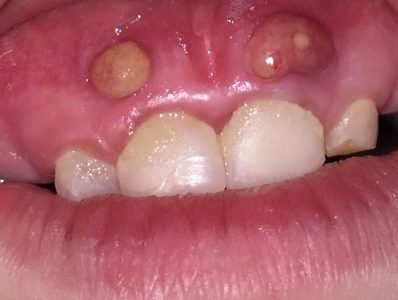 Dental infection