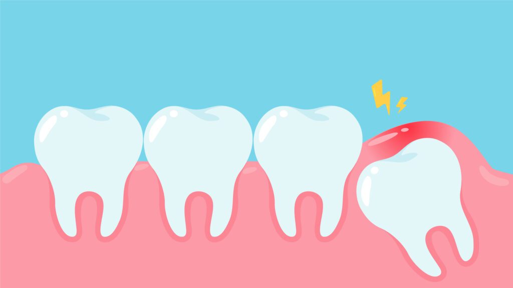 Wisdom teeth under the gums